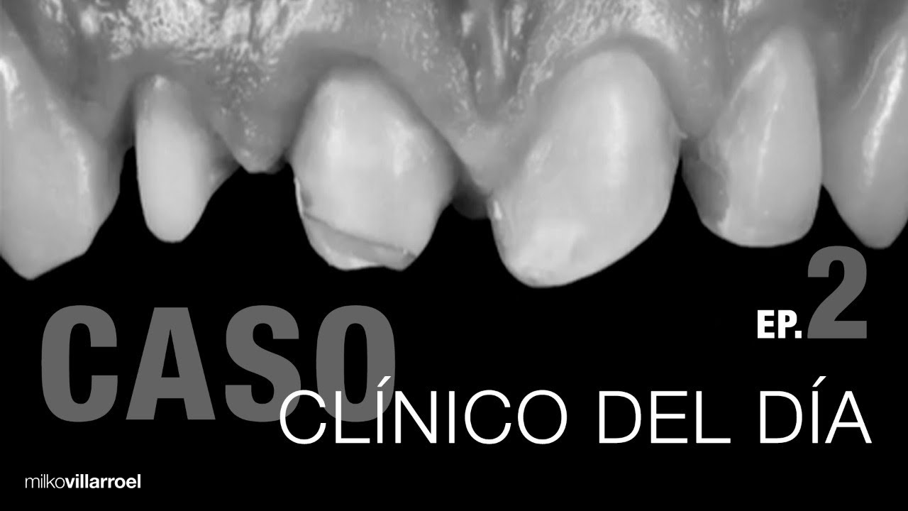 Coronas y laminados en un mismo caso…dolor de cabeza!!! | #CasoClínicoDelDía | Milko Villarroel