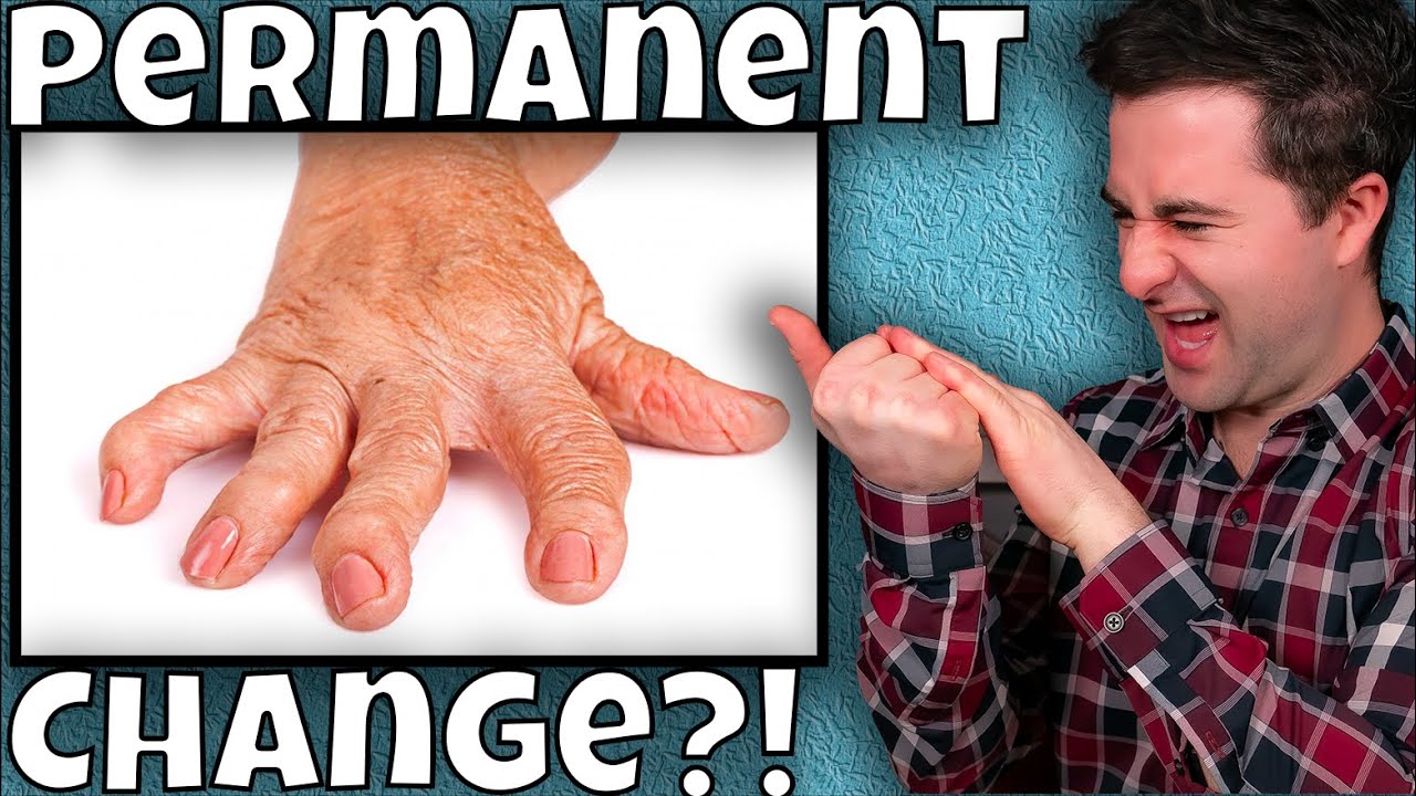 Does Knuckle Cracking Cause Arthritis?