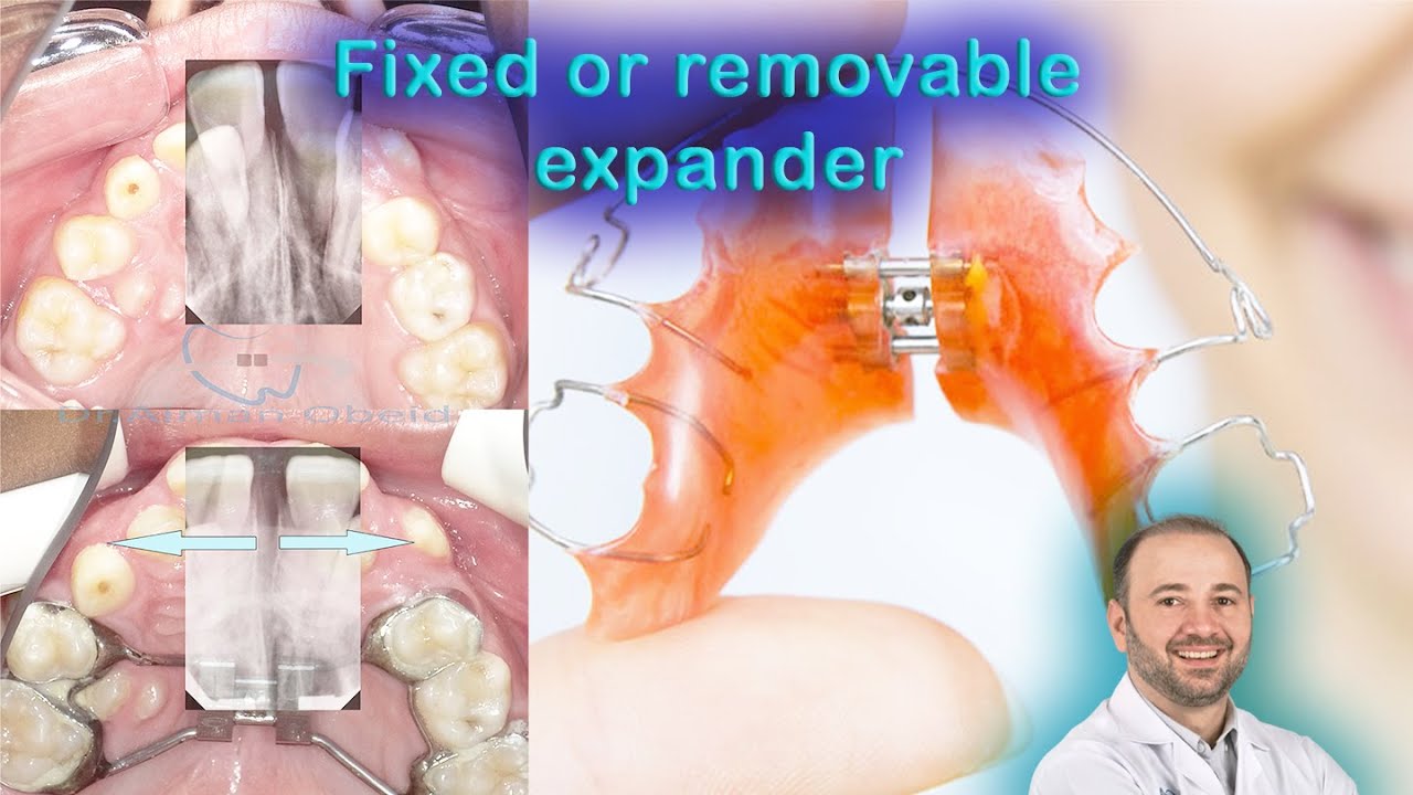 Hawley expander or hyrax expander, difference with fixed hyrax expander & MSE expander for adults