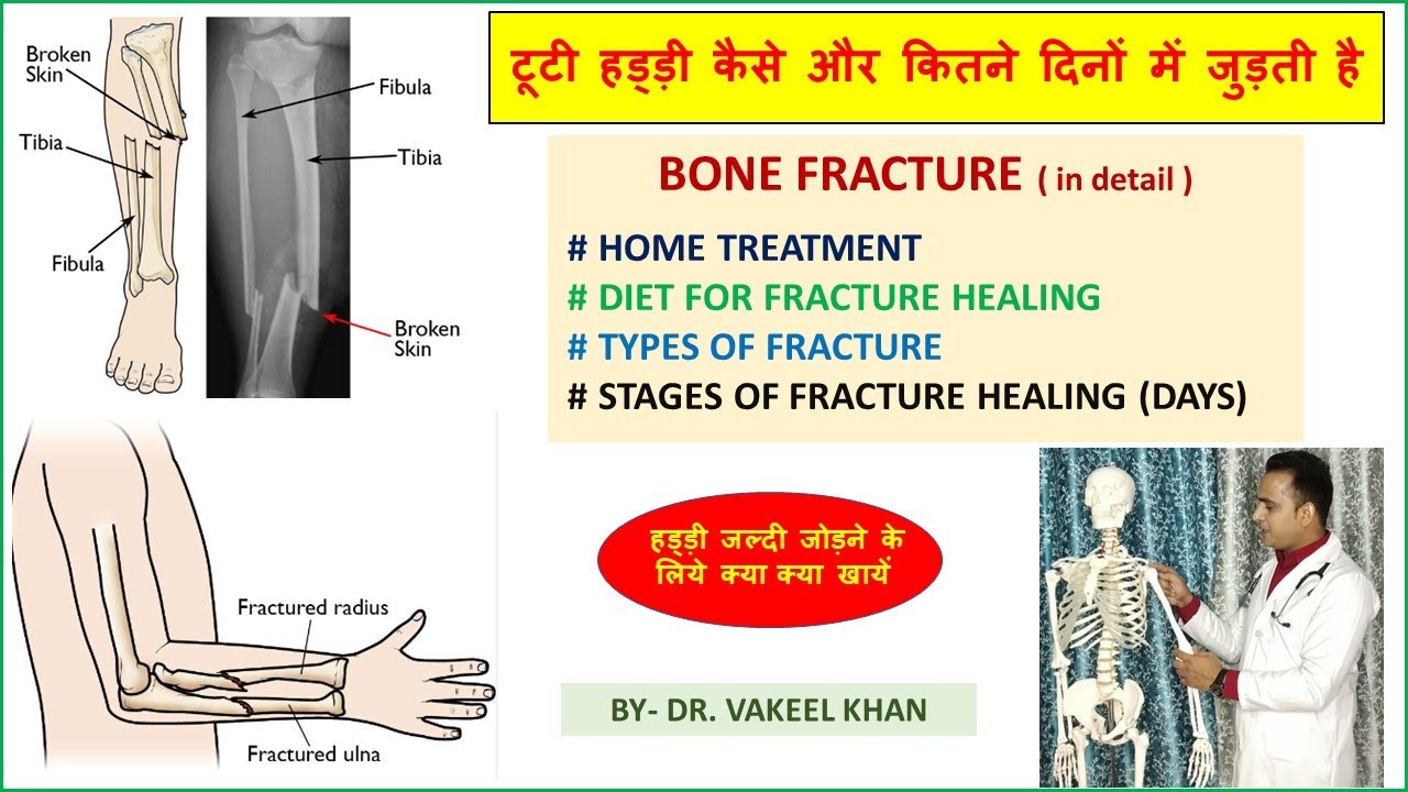 FullVideo 👉टूटी हड्डी कैसे और कितने दिनों में जुड़ती है | BONE FRACTURE-Recovery Time, DIET TREATMENT
