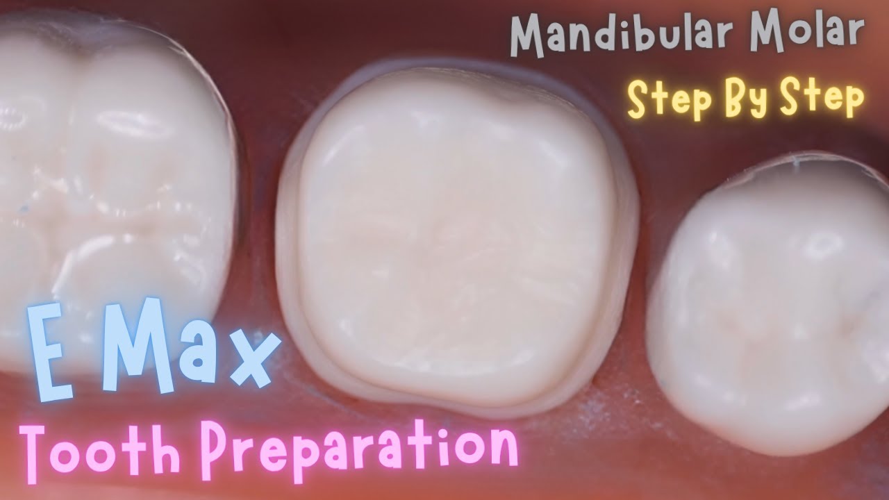 Emax Crown ⚪️ Tooth Preparation 🟡 Mandibular First Molar 🟣 Step By Step