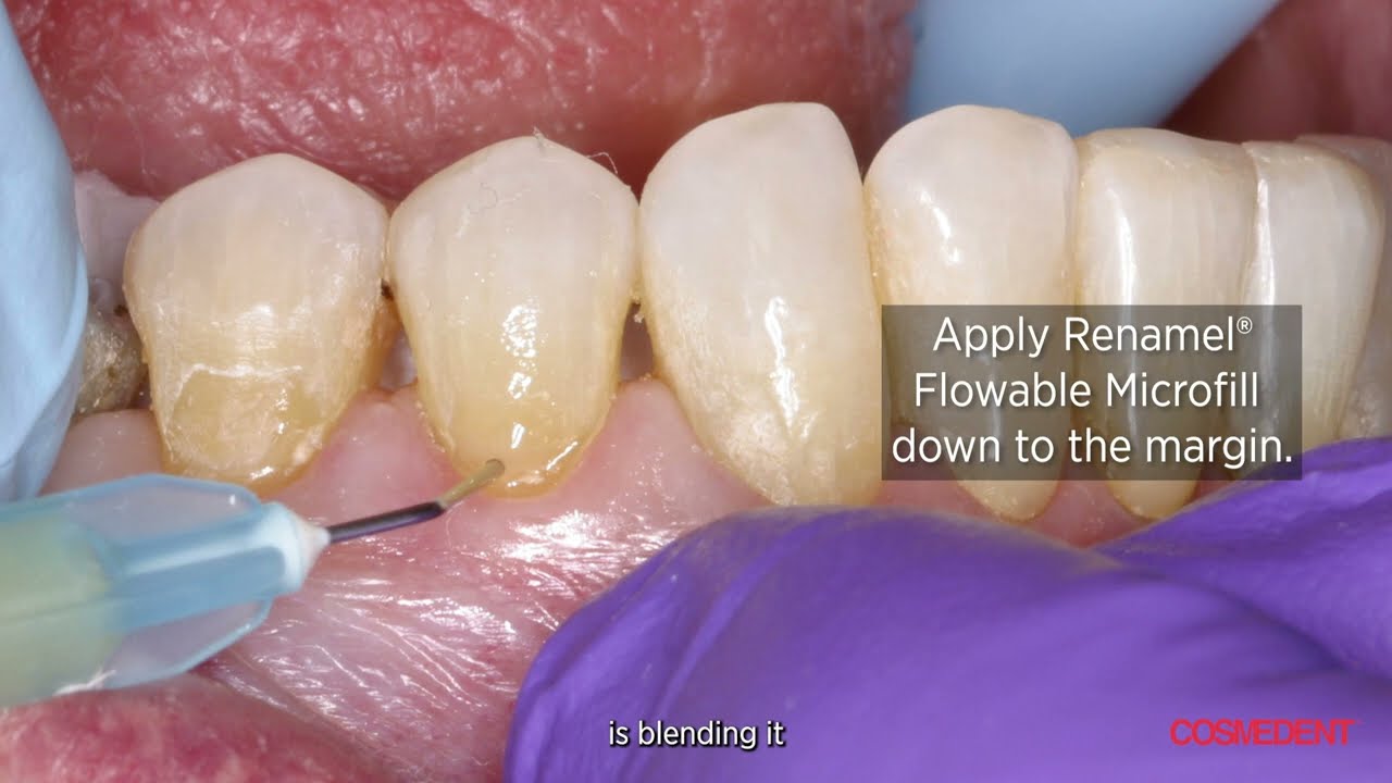 Class V Cervical Restorations