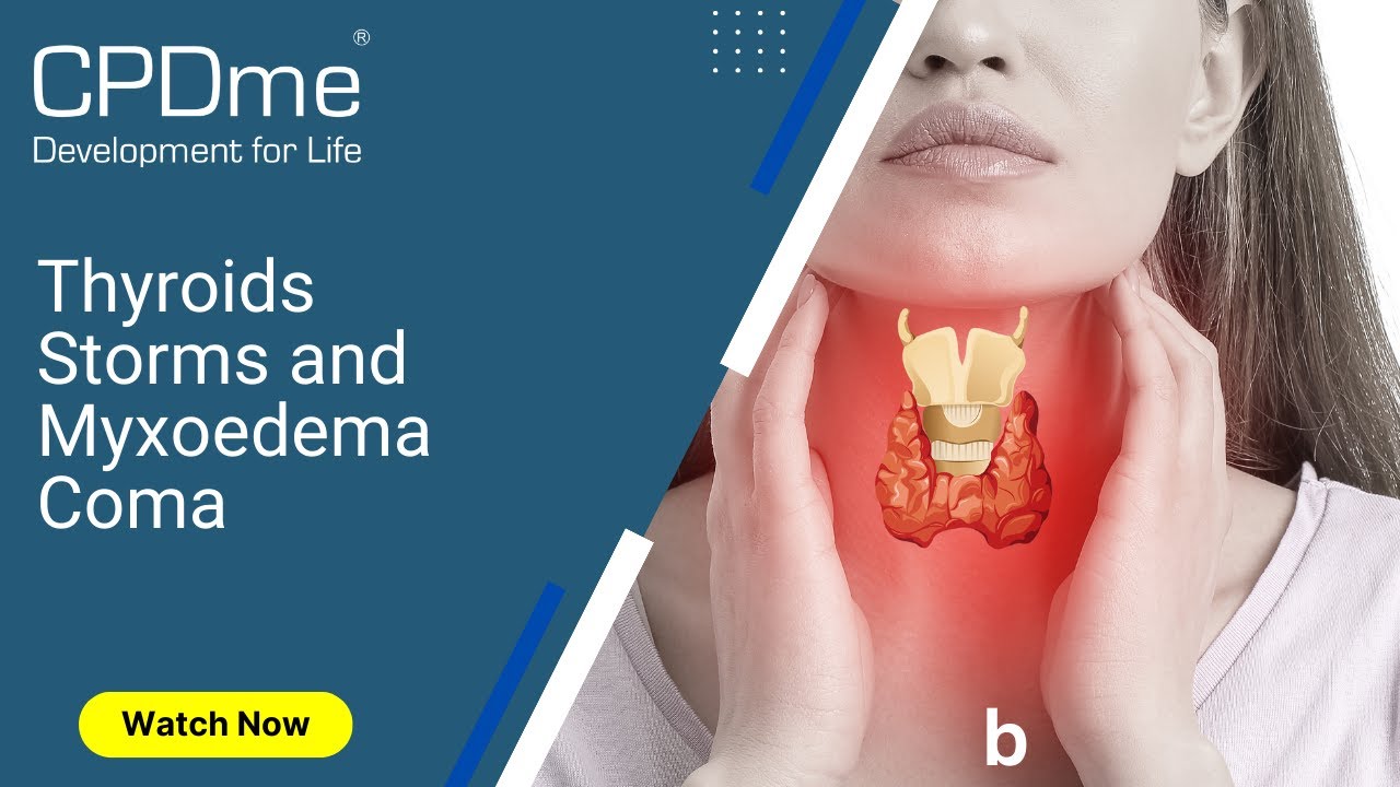 Thyroid Storms and Myxoedema Presented by Dr Akash Doshi
