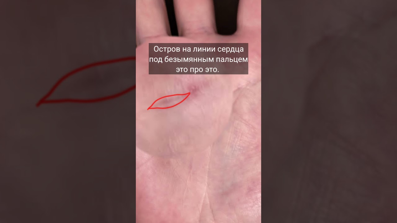 Проблемы со зрением на ладони парня#хирология