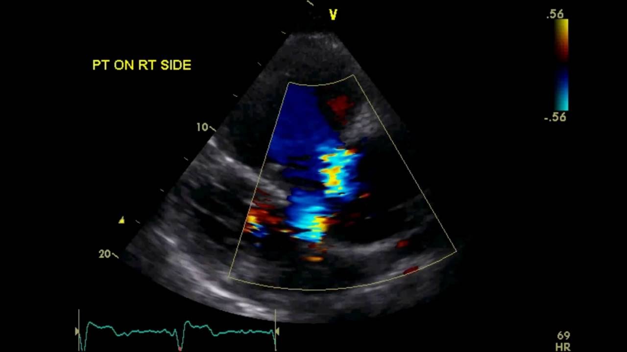 Congenitally Corrected Transposition of Great Arteries - TTE