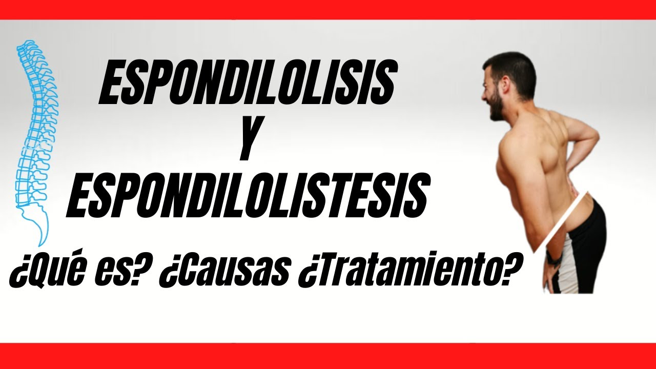 ¿Qué es la ESPONDILOLISIS y ESPONDILOLISTESIS??? [CAUSAS] [SÍNTOMAS] [TRATAMIENTOS] Evidencia 2021