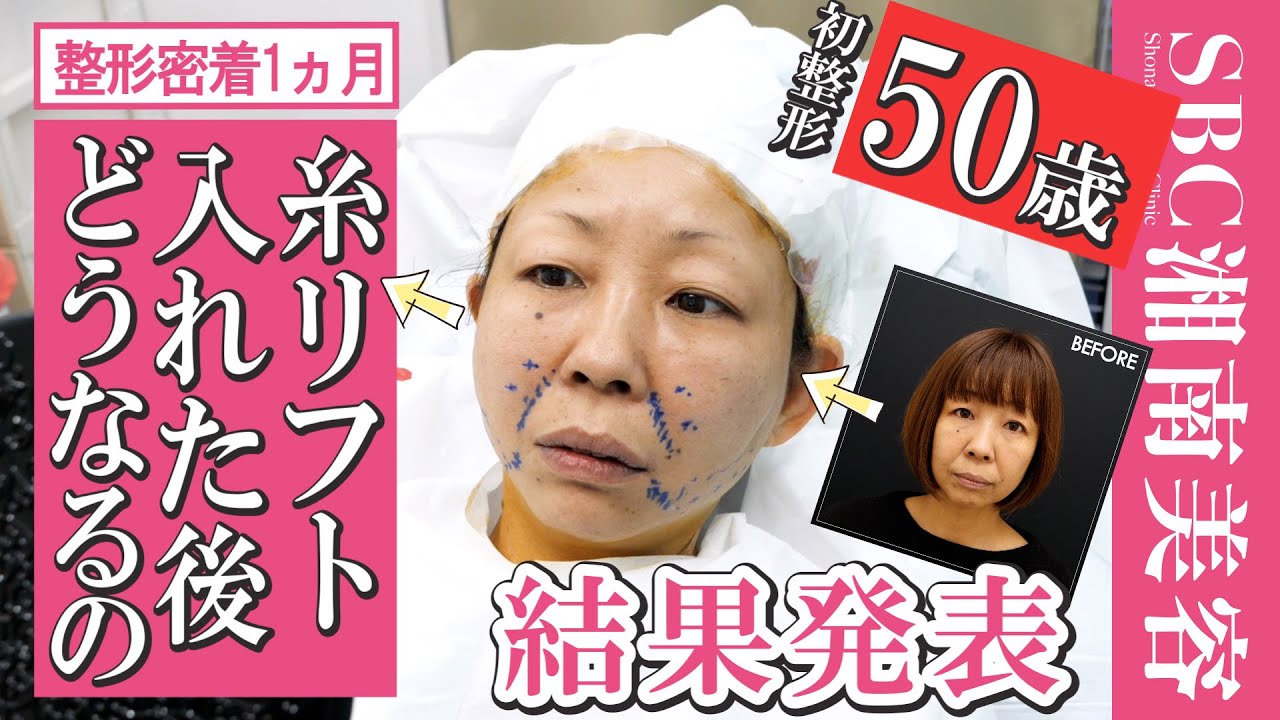 【アラフィフ糸リフト整形密着】ダウンタイム完全公開！若返り度・痛み・肌質の変化を正直レポートしました【タルミ・ほうれい線・フェイスラインを引き上げて小顔】＠湘南美容クリニック