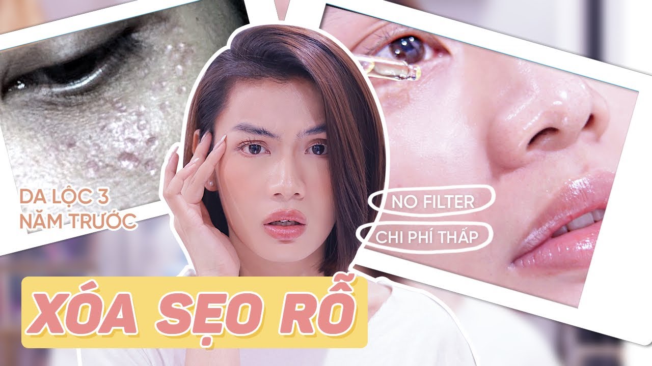 Luna Đào | Nhật Ký trị SẸO RỖ hiệu quả tại nhà | Tất tần tật các phương pháp trị sẹo rỗ 100%