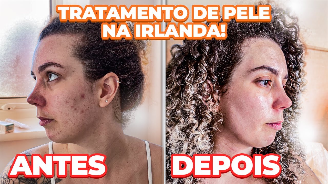 COMO CUREI MINHAS ESPINHAS NA IRLANDA - COM VALORES | Dermatologista na Irlanda | Maria Quer Viajar