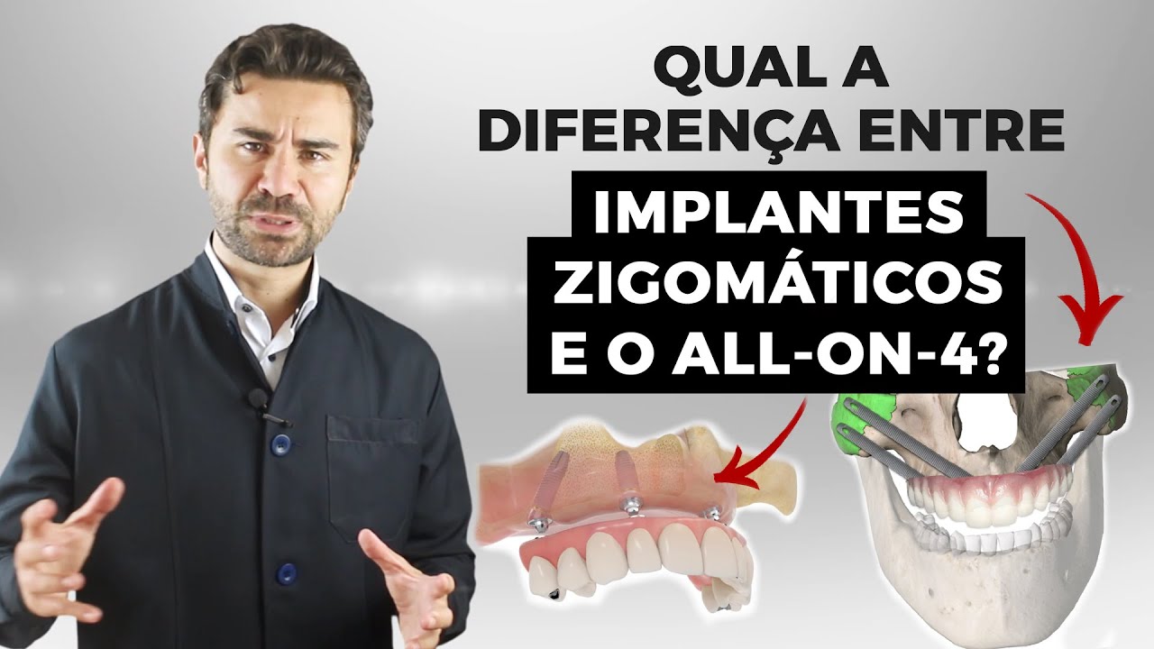 Qual a Diferen&ccedil;a entre Implante Zigom&aacute;tico e Allon4?