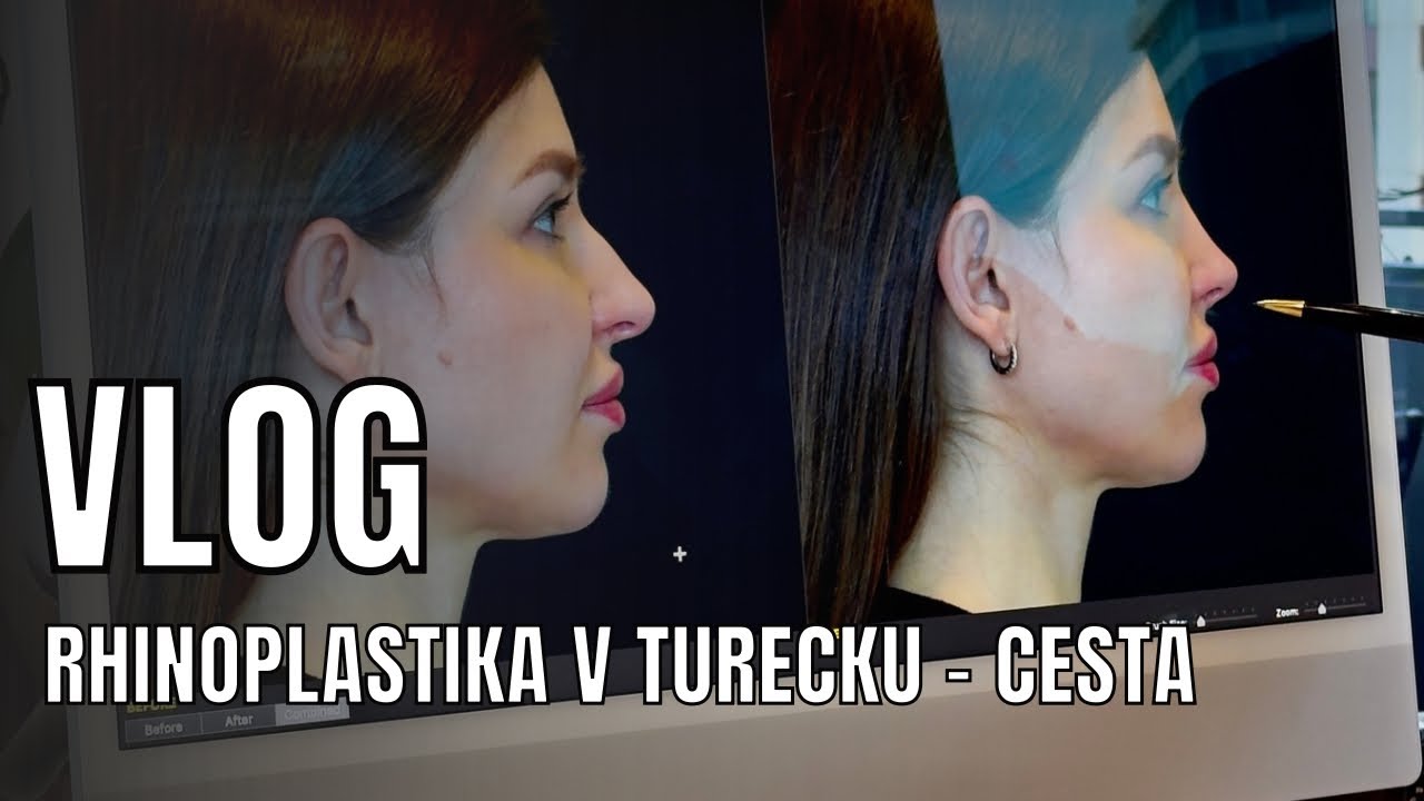 Rhinoplastika v Turecku - septoplastika, úprava nosu 