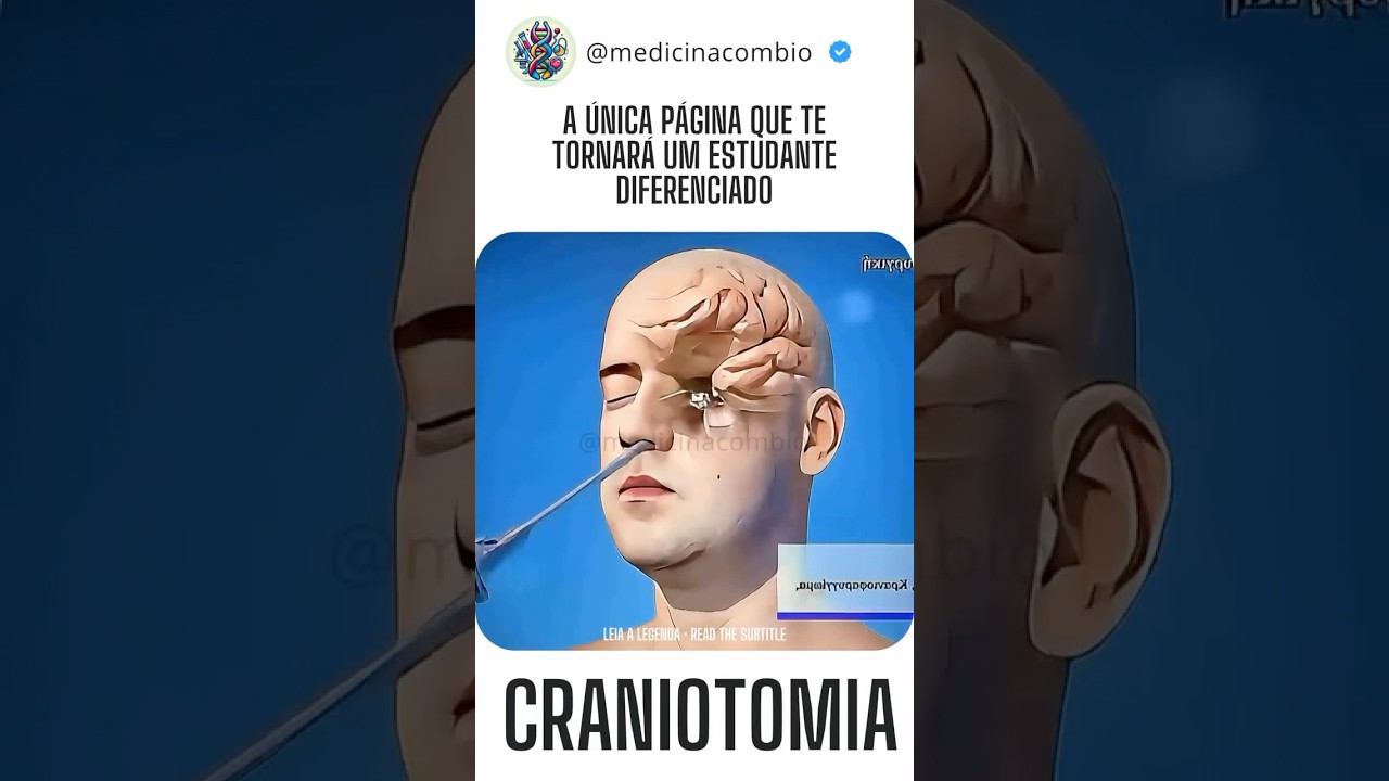 Craniotomia #craniotomia #craniofacial #neurosurgeon #neurosurgerytraining #medicina #medstudent