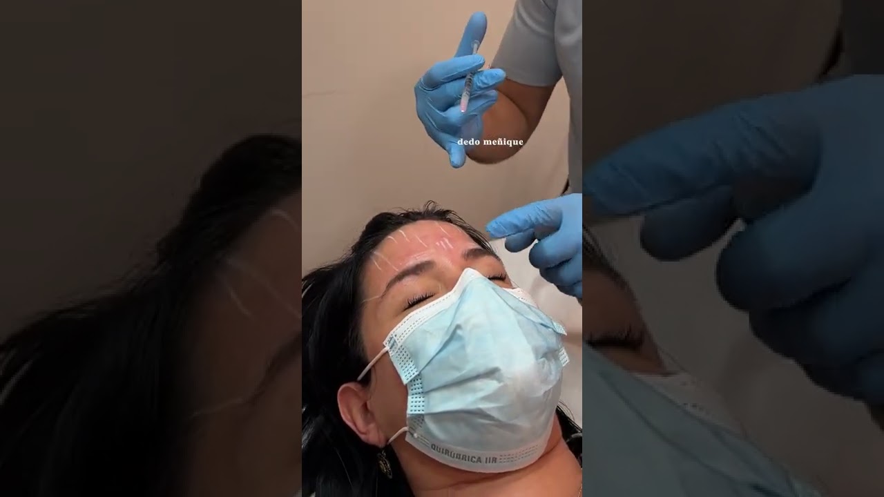 Cuanto Botox se usa para tratar el rostro?