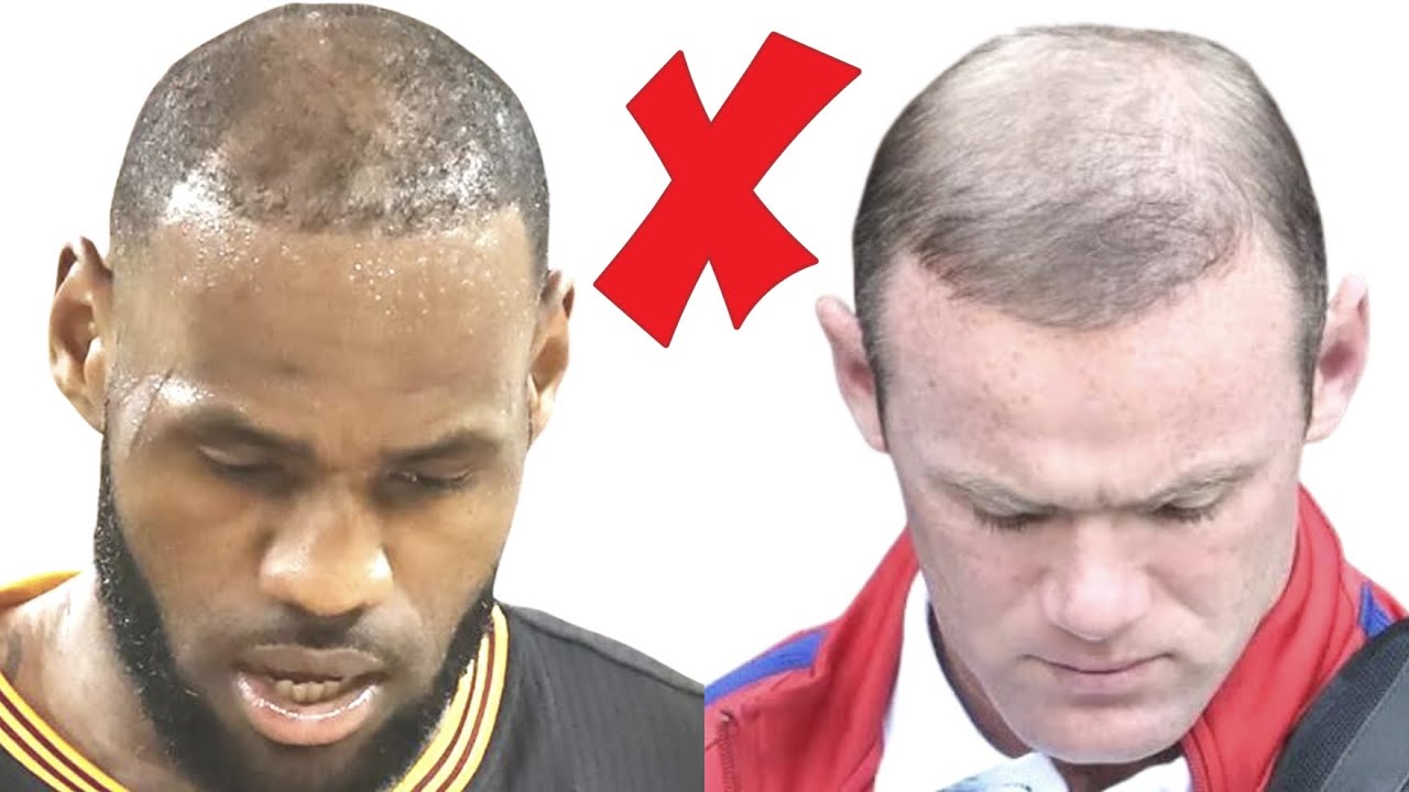Hair Transplants without Finasteride Suck...