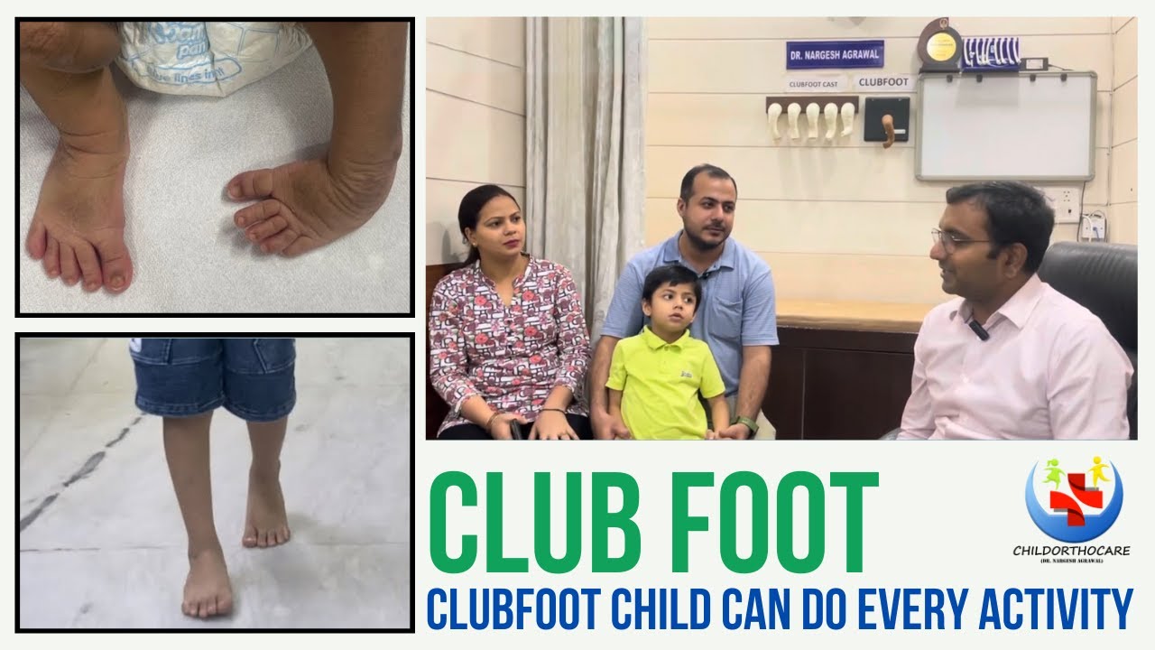 Successful Clubfoot treatment In Delhi ll  टेडे मेड़े पाँव का इलाज #clubfoot