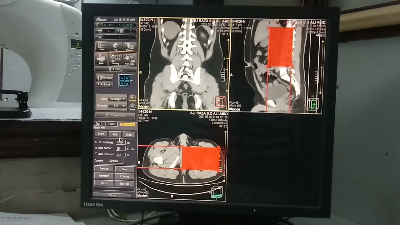 #filimg #Kub plain#How to reconstruct imges of Ct KUB. Toshiba
