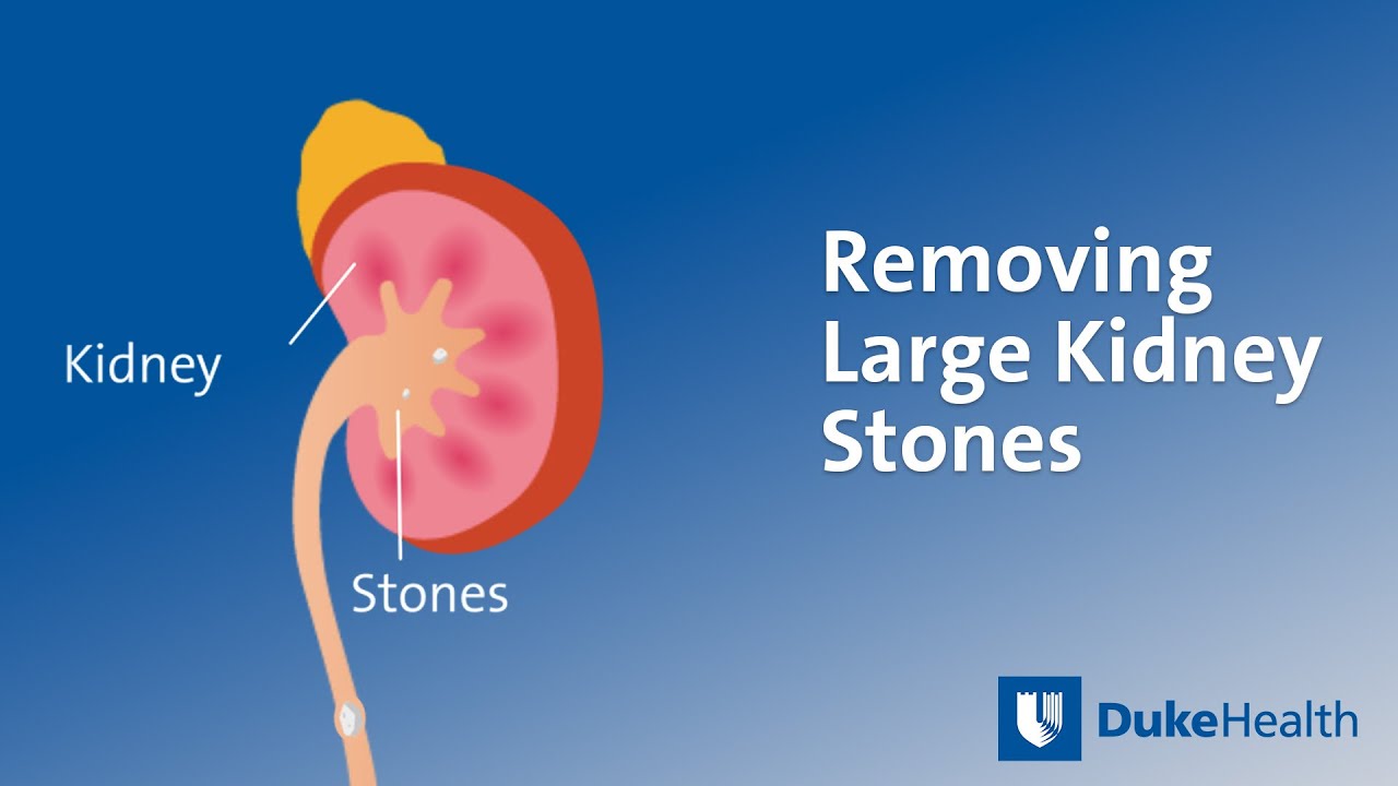 Removing Large Kidney Stones | Duke Health