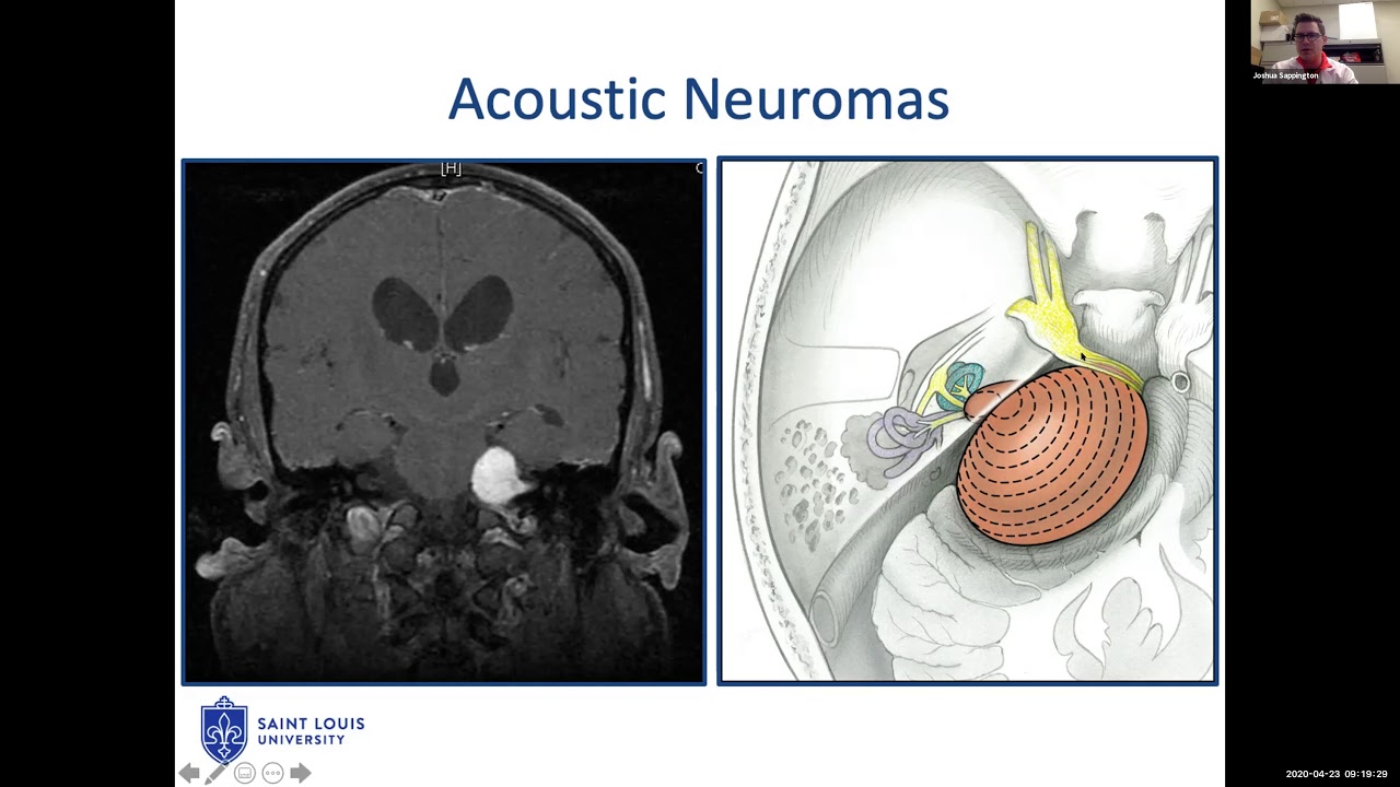Lateral Skull Base Imaging and Management - Dr. Joshua Sappington
