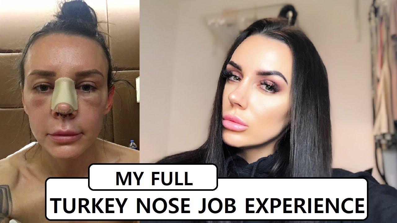 TURKEY NOSE JOB VLOG & STORY - FULL EXPERIENCE!!