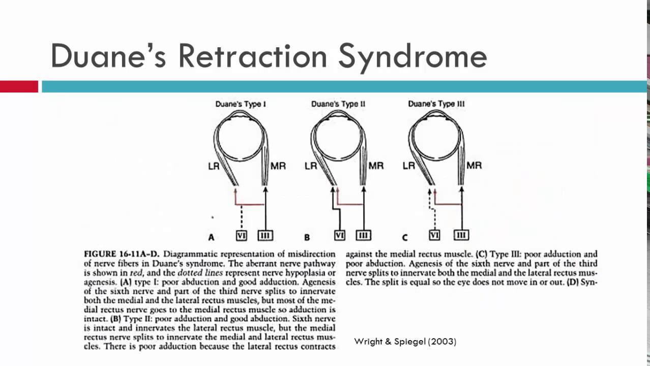 Duane's Retraction Syndrome Aetiology