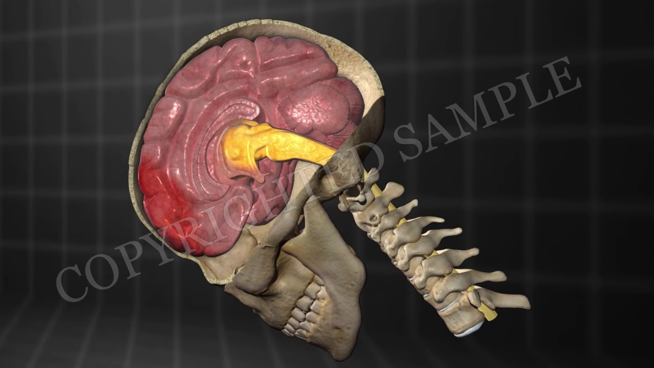 Forensic Animation Brain Injury Stem Stretch