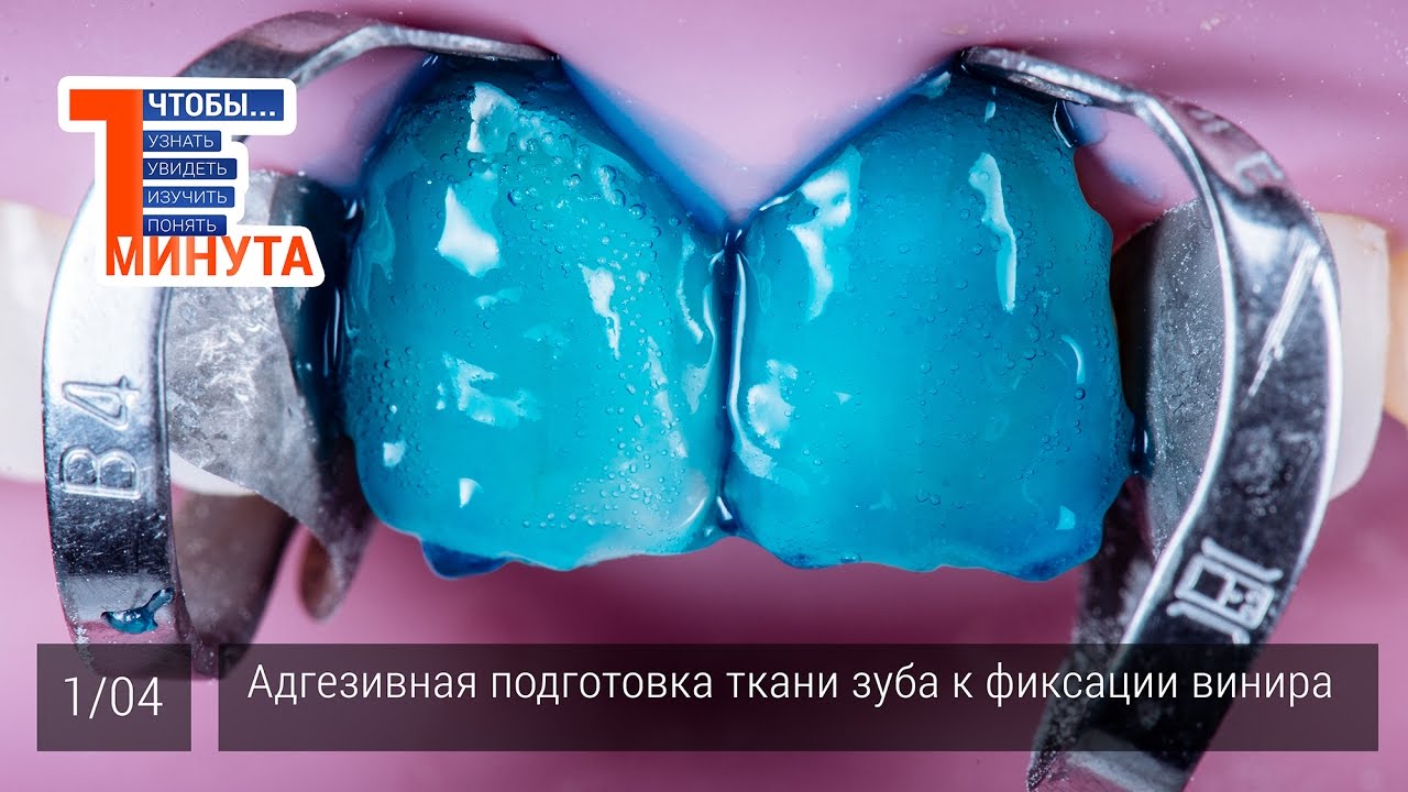 Как адгезивно подготовить ткани зуба к фиксации винира. Серия 1/4