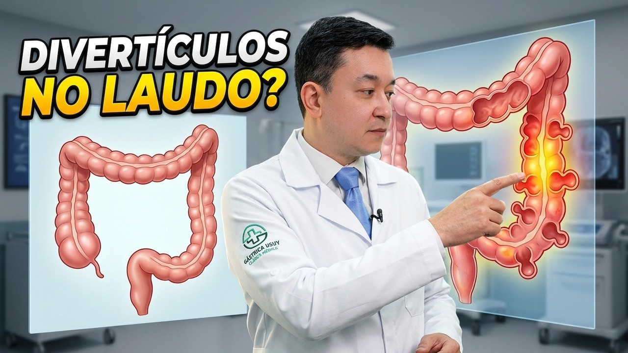 Divertículos, diverticulose ou doença diverticular: o que significa no laudo?