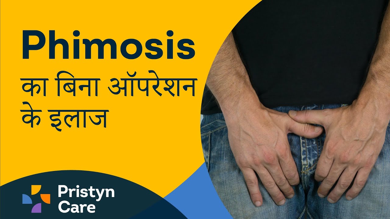 Treatment of Phimosis without operation - For FREE Consultation Call On 08065417725