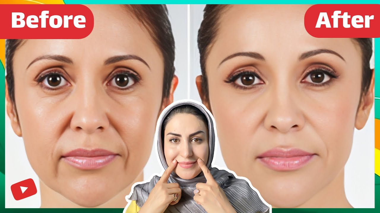 لیفت صورت و درمان افتادگی گونه | با روشی کاملا طبیعی جایگزین بوتاکس، پروتز و عمل جراحی