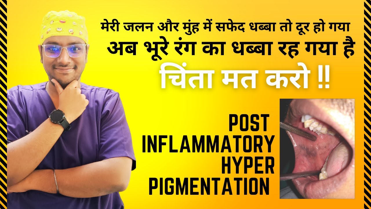 Dr Rudra | मुँह में जलन और सफेद पैच ख़तम पर भूरा निशान क्यों ? Post Inflammatory Hyper Pigmentation