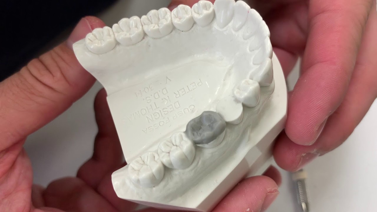Dental School: Anatomic Wax-Up Of Molar #30