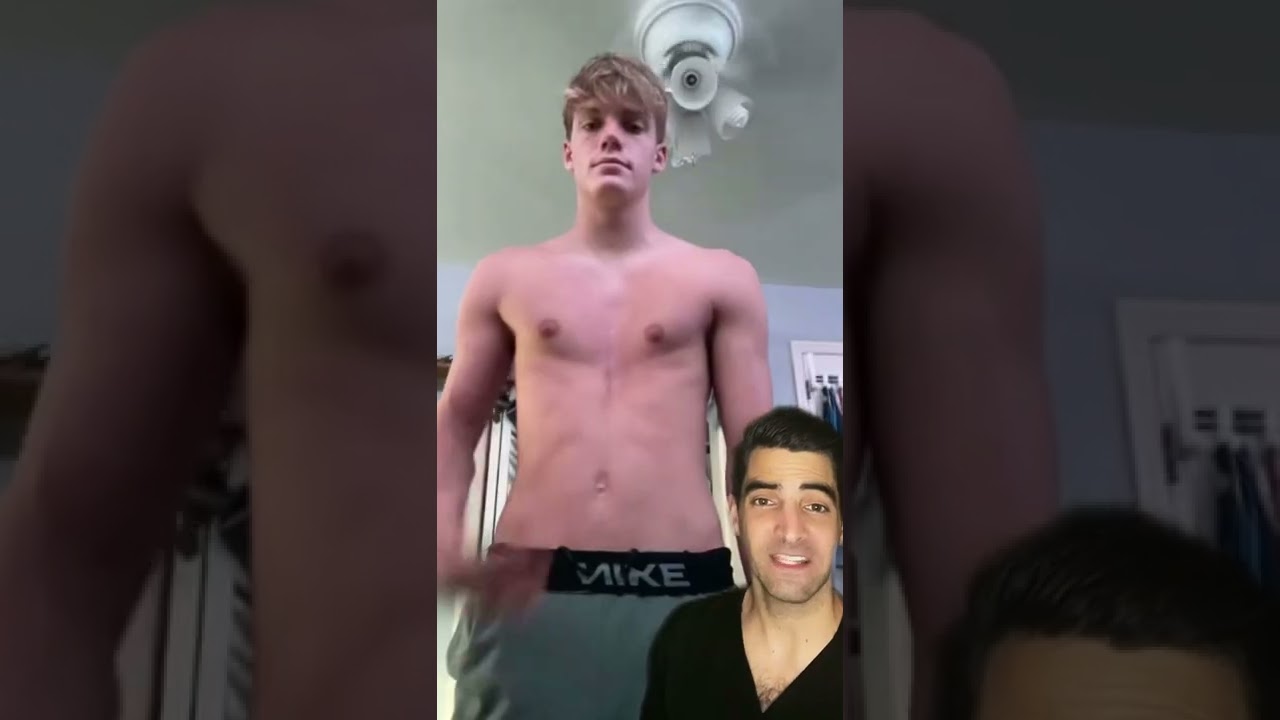 Pectus Excavatum