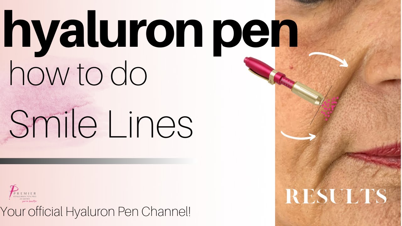 How to do Nasolabial Lines/ Smile Lines / Marionette Lines Hyaluron Pen Filler