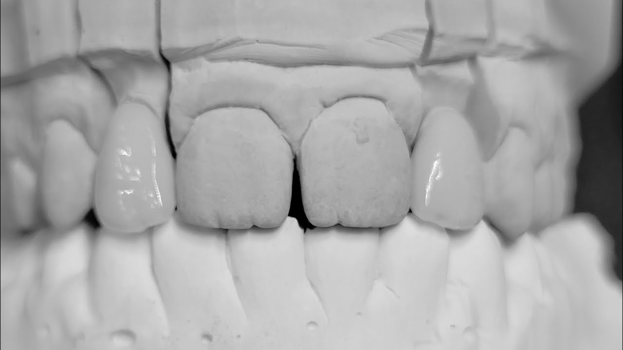 ASMR E‑Max Crown Layered & E-max Layered Veneer / Coroana E-MAX Stratificata & Fateta E-MAX