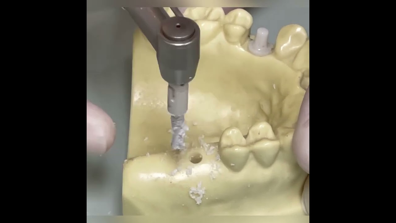 Z-systems tissue level implant instrument kit and placement tutorial