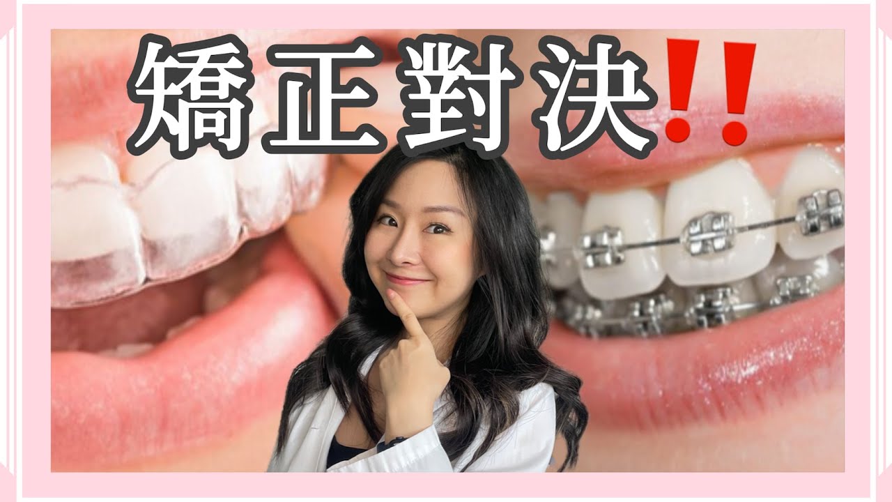 『震撼對決！隱形矯正 vs 傳統矯正』：隱適美前 絕對要知道的這6件事！@DrTeresa @DrTeresa
