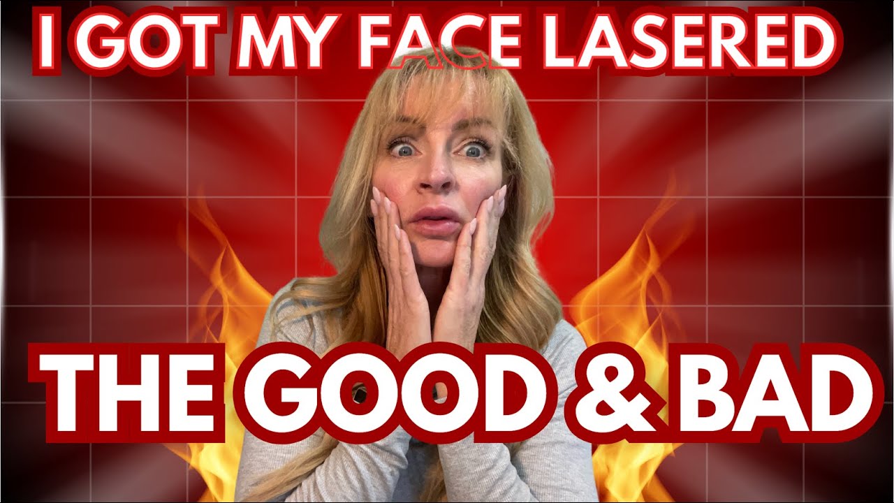 I Got My Face Lasered and Here's What Happened!