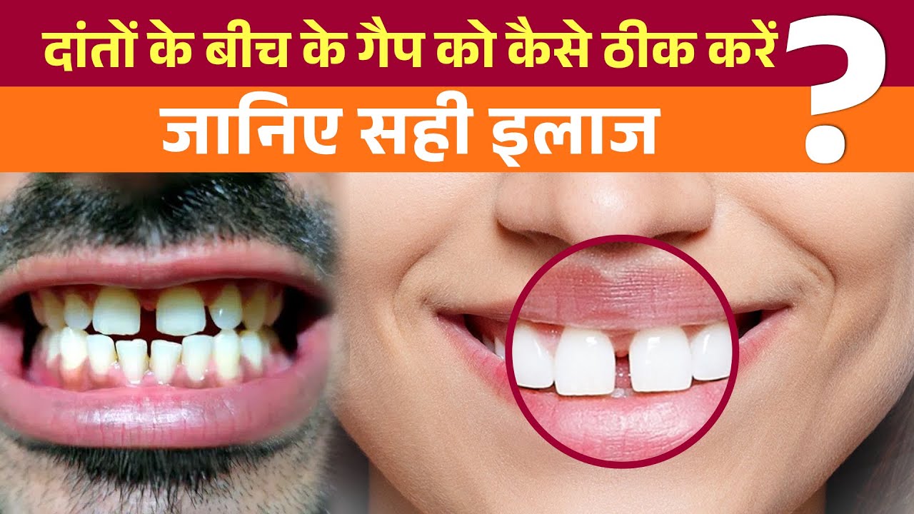 Teeth Gap का Permanent इलाज – Smile Without Hesitation! | दांतों के गैप से छुटकारा पाएं हमेशा के लिए