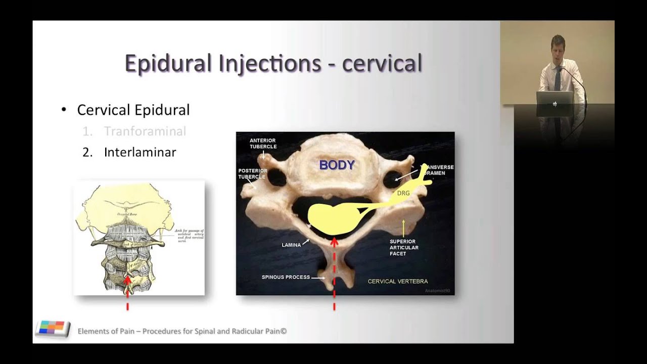23. Procedures for spinal and radicular pain