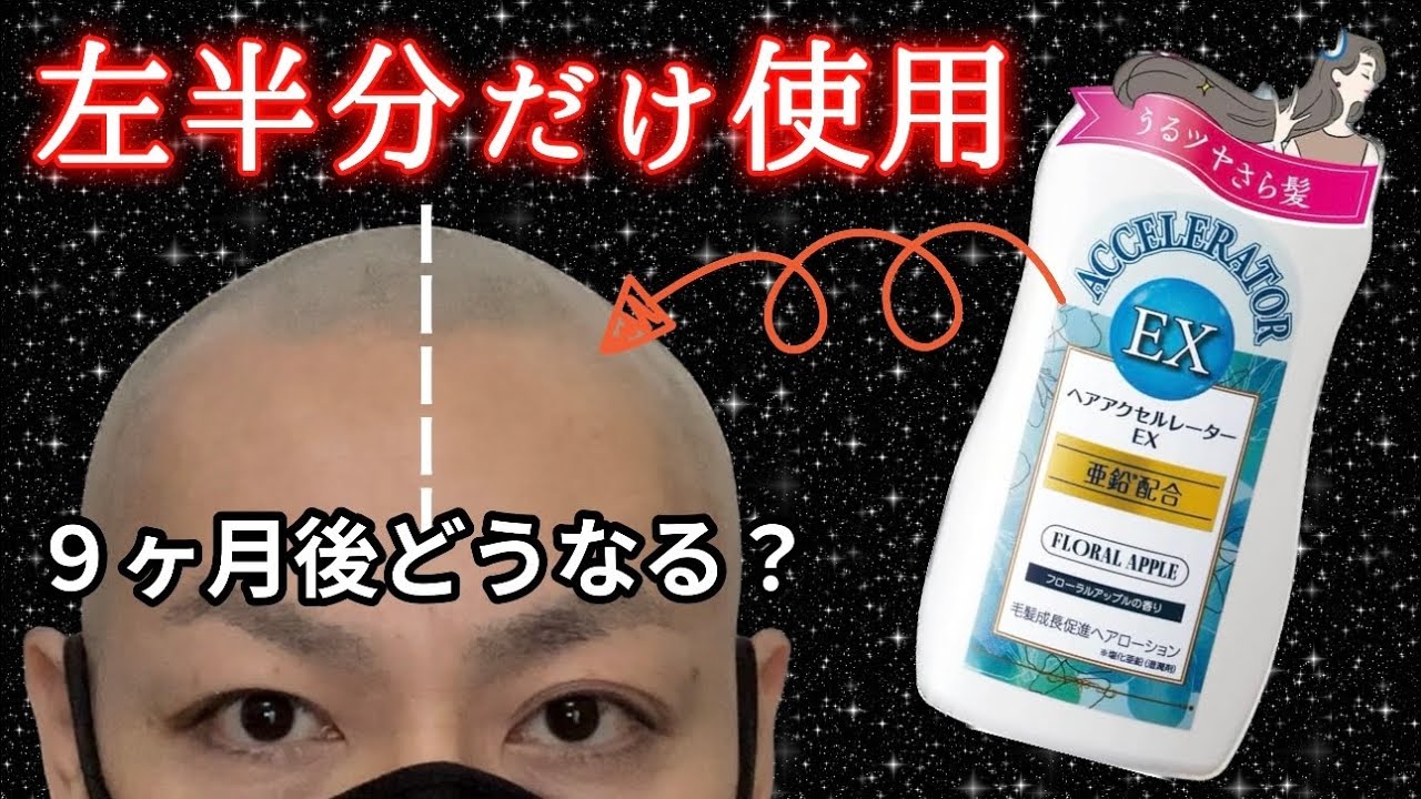 【爆速で髪が伸びる？】ヘアアクセルレーターEXを９ヶ月使用した結果…。