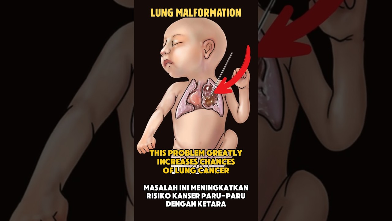 Lung Malformations in Children: Why Thoracoscopic Surgery Is the Safer Option #paediatricsurgery