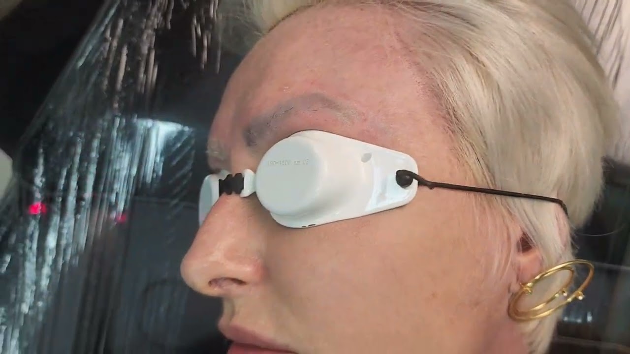 sobrancelha camuflada ficou verde após laser, erro da micropigmentadora e erro com laser #youtube