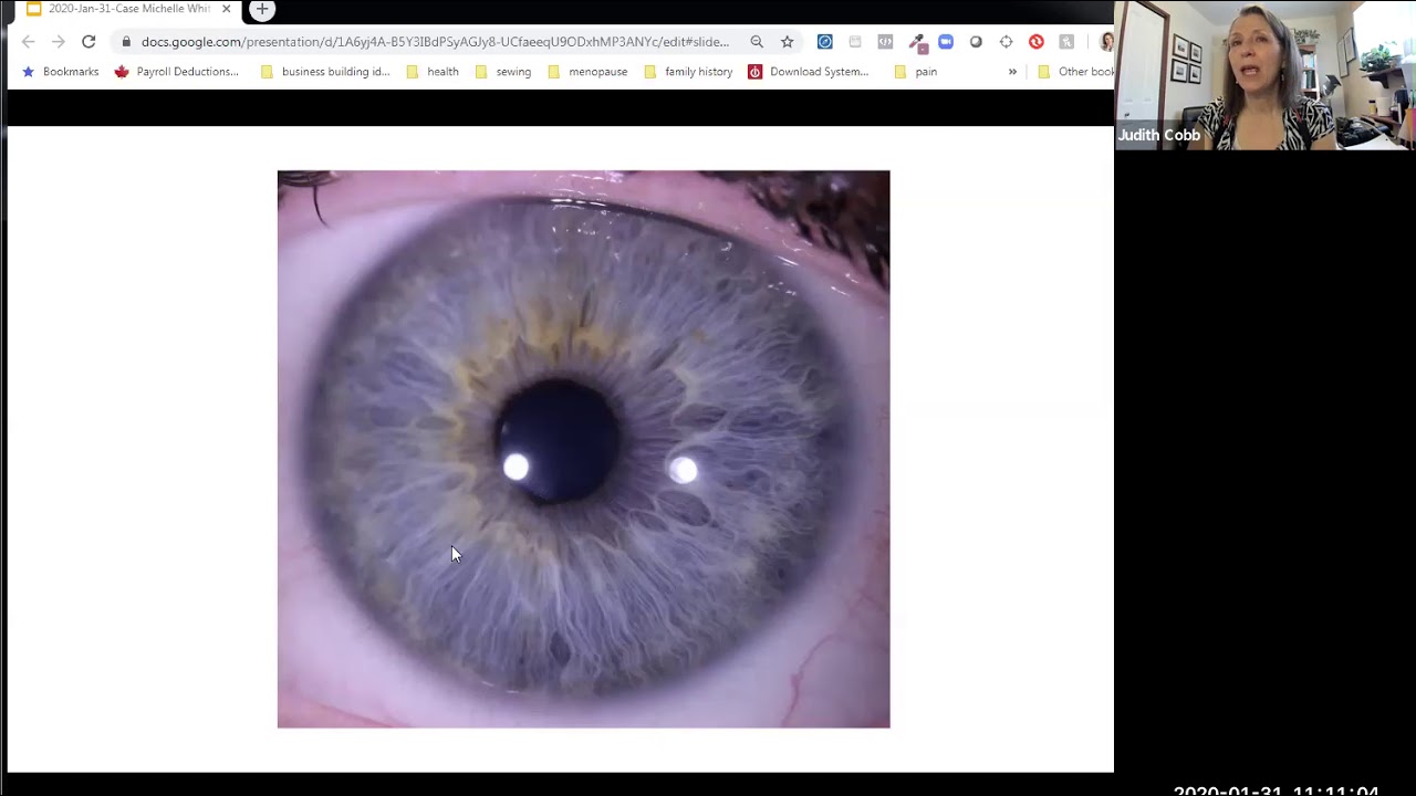 A Constitutional Iridology Case Study