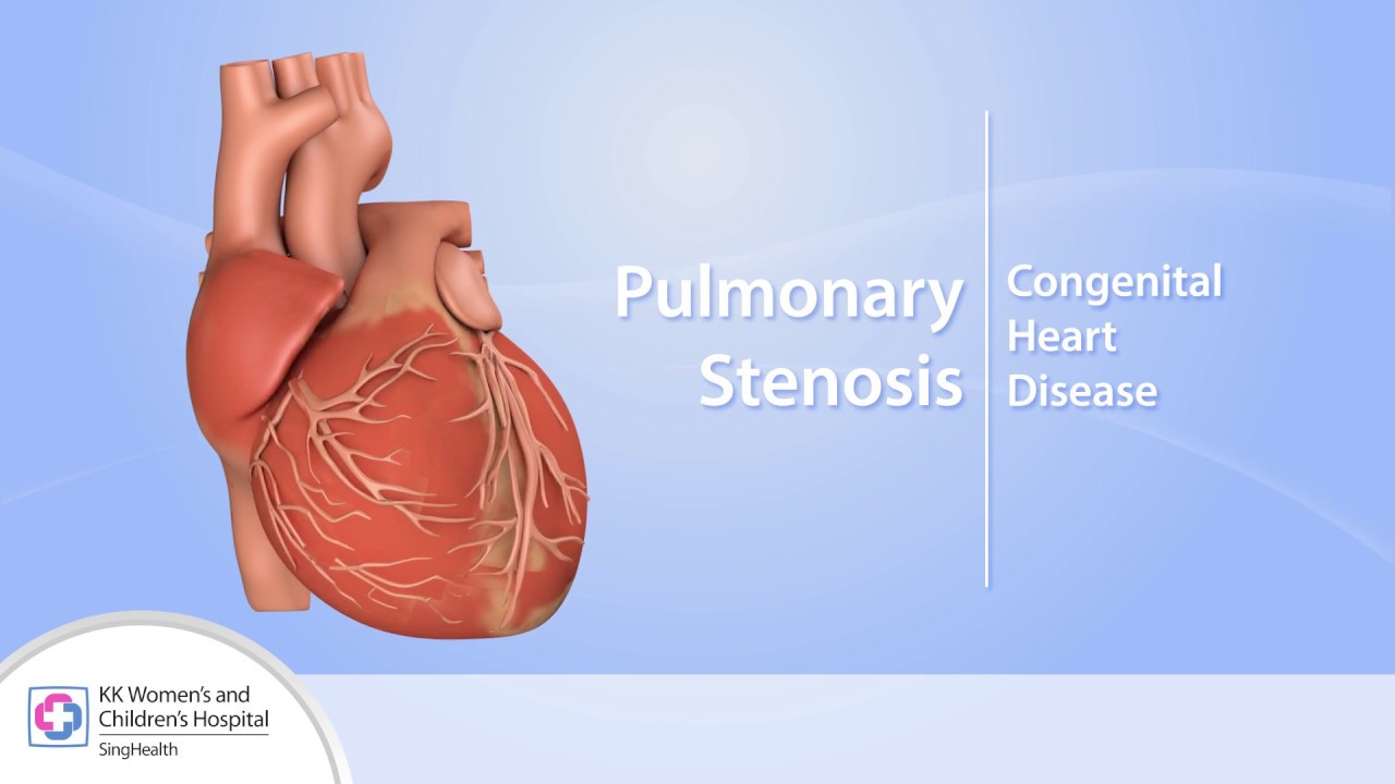 Heart Conditions – Pulmonary Stenosis