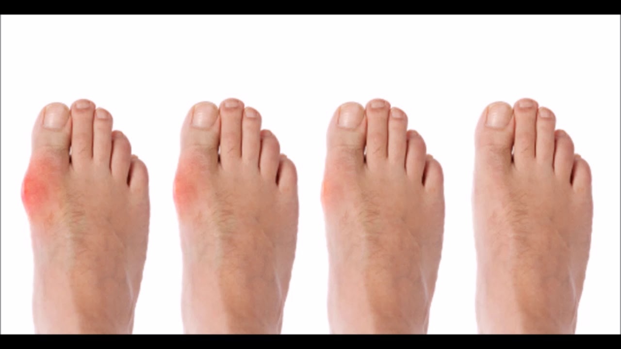 Hallux Valgus - RUCK Druckschutz