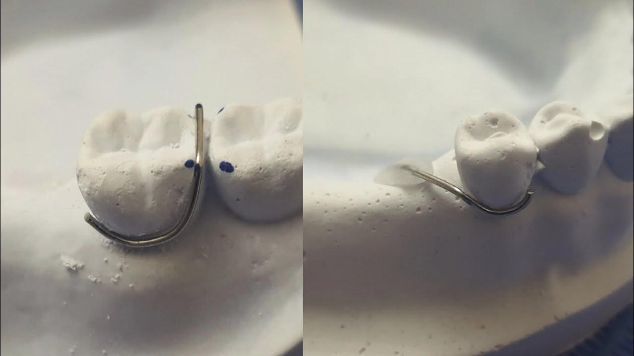 circumferential and half jakson clasps💯 أسهل طريقة لعمل الكلاسبات وتريكات مهمة جدا💥💥💥