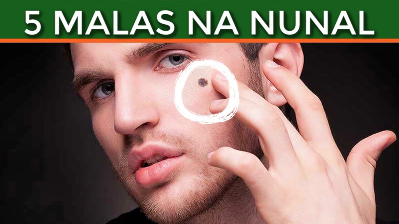 Mga MALAS na Nunal sa Mukha - Meron Ka Ba Nito?