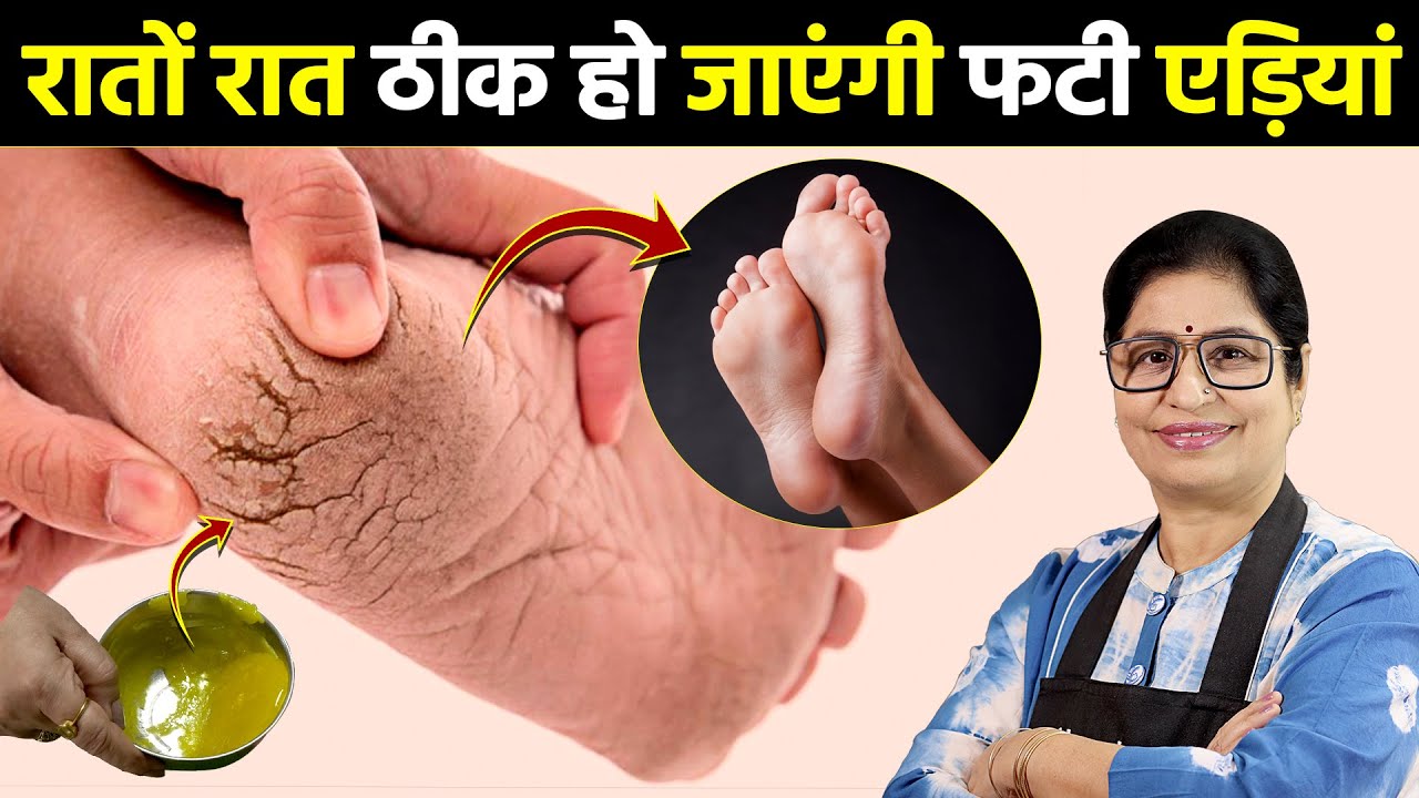 मेरे बताये इस घरेलू नुस्खे से फटी हुई एड़ियों से हमेशा के लिए छुटकारा पाएं Cracked Heels Home Remedy