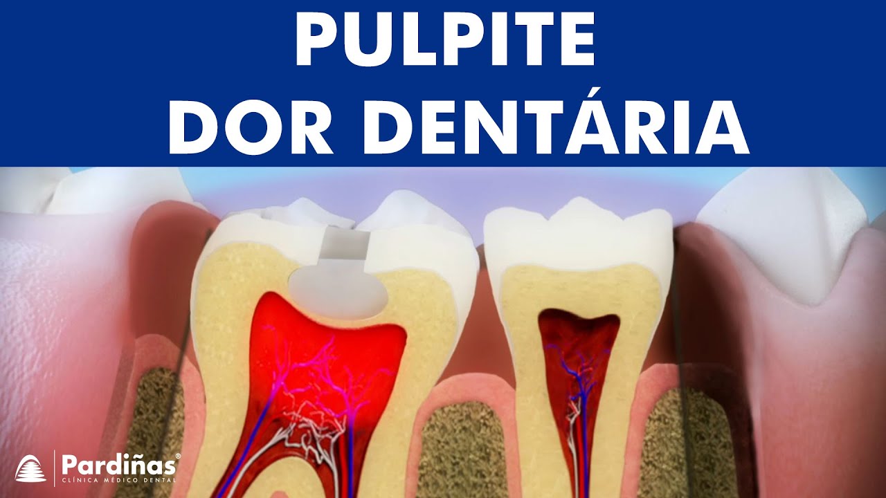 Pulpite - Inflama&ccedil;&atilde;o da polpa dent&aacute;ria &copy;