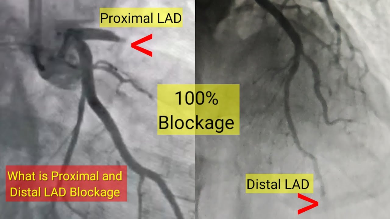 What is proximal and Distal LAD artery  Blockage and Treatment l हार्ट ब्लॉकेज और ईलाज